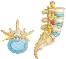 โรคหมอนรองกระดูกเคลื่อนทับรากประสาท (Herniated disc)
