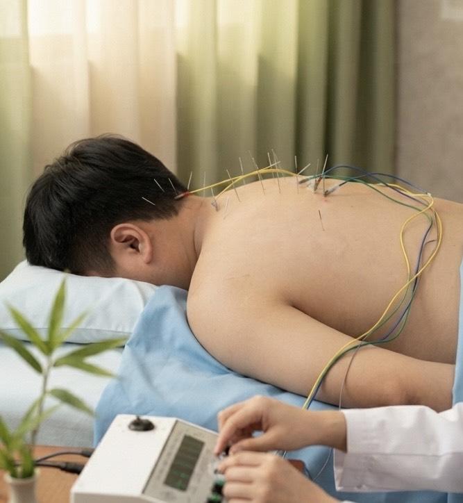 ฝังเข็มศาสตร์แพทย์แผนจีน ทางเลือกสำหรับคนที่มีอาการปวดกล้ามเนื้อ