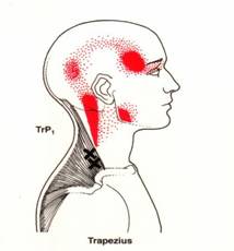 การฝังเข็มในโรคกล้ามเนื้อหดเกร็ง (Dry needling puncture in Myofascial pain syndrome)